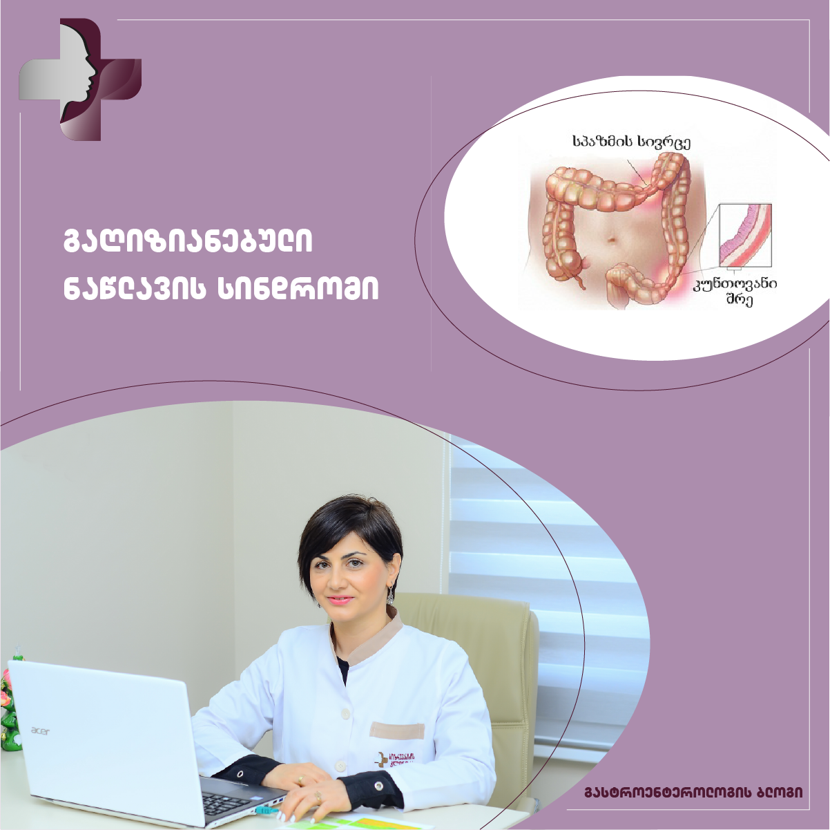 გაღიზიანებული ნაწლავის სინდრომი